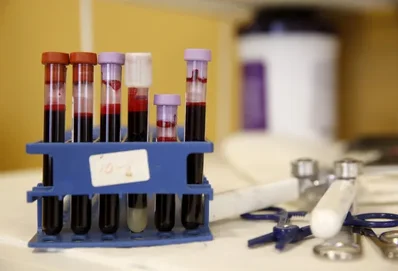 การบำบัดด้วยเซลล์ของ Legend Biotech ประสบความสำเร็จในการทดลองระยะแรก